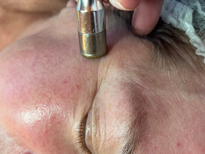 Dermabrasion
